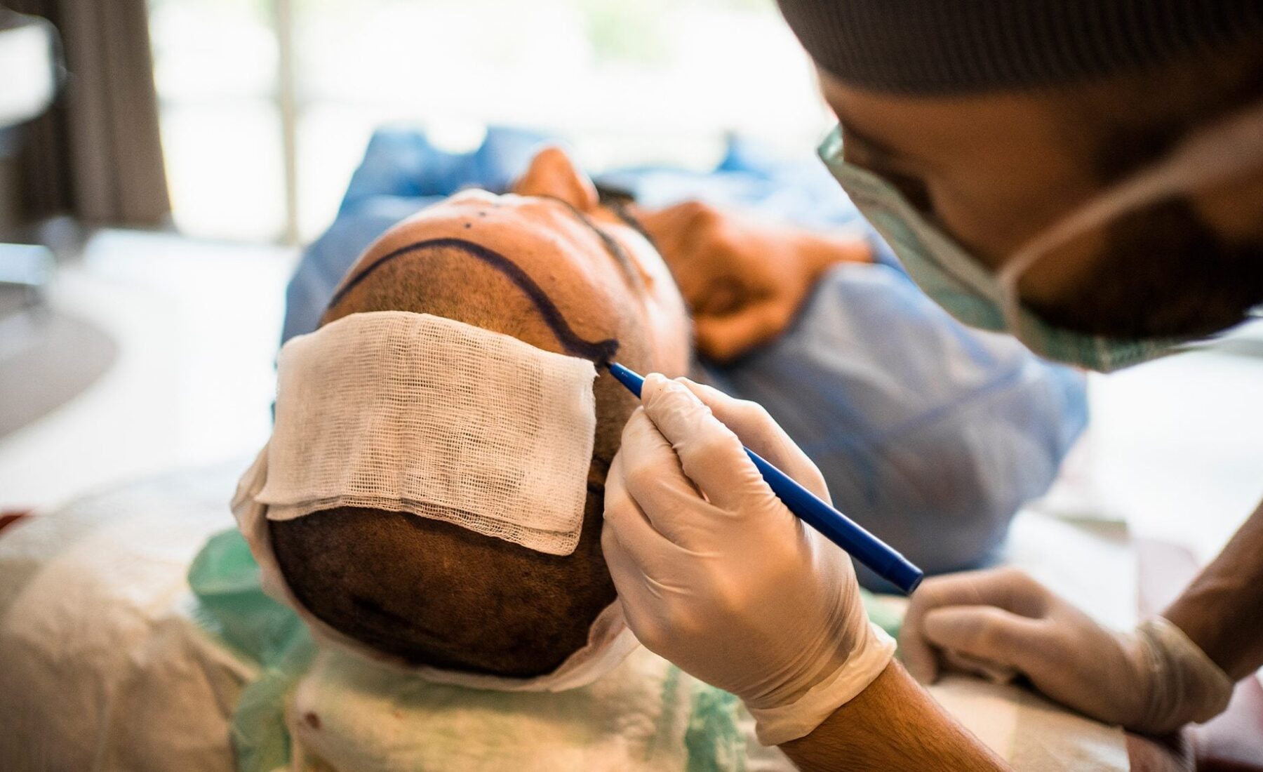 What You Need To Know Before Getting A Hair Transplant In Turkey
